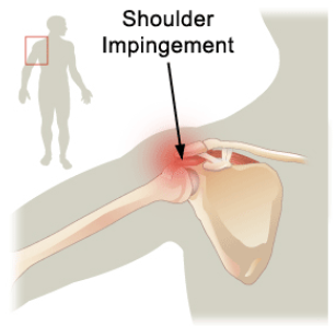 shoulder impingement syndrome